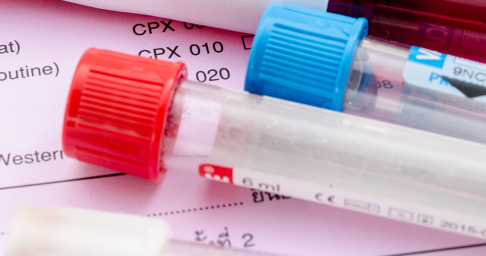 Blutentnahmeröhrchen mit HIV-Testetikett
